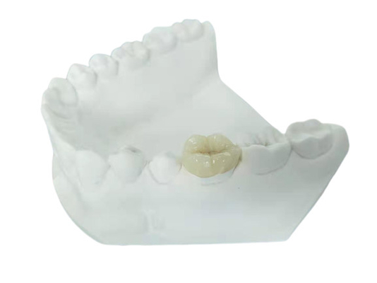 Het duurzame van het de Kroonvernisje van FDA alle-Ceramische Tandinlegsel Gelijkaardige Onlay