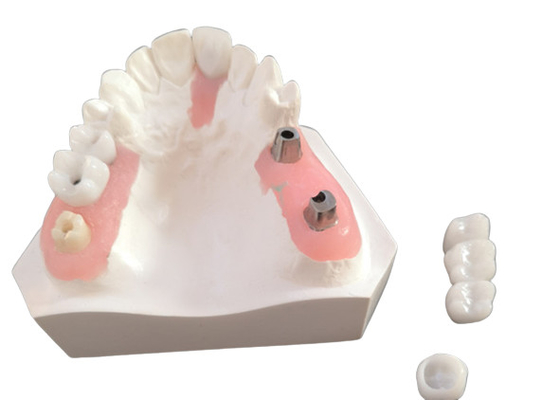 FDA Alle Zirconia kroon met implantaat ondersteunde tandheelkundige prothesen voor tandheelkundig laboratorium