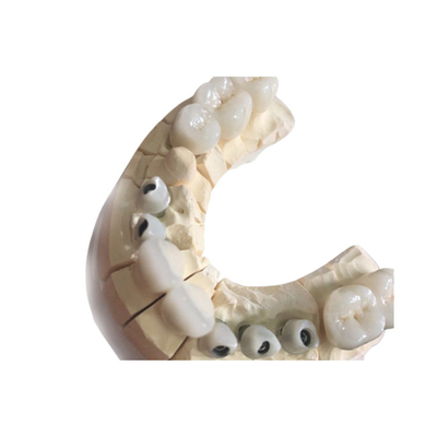 Op maat gemaakte tandkronen van zirconia Uitstekende esthetiek Duurzaam materiaal