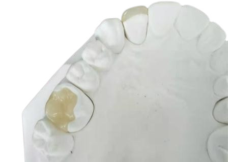 Duurzame Flexibele PFM-Tandips E Max Press Inlay Onlay van de Brugkroon
