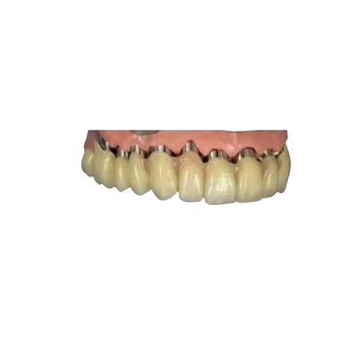 CAD CAM PFM Implant Telescopische de Kroon Tand 3D Gedrukte Modellen van de Kroonbrug