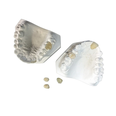 Gemakkelijk handhaaf OEM het Witte Ceramische Tandinlegsel Onlay van het Kroonvernisje