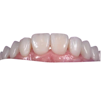 0.3MM Wittende Ceramische Tandkroon om Ongezonde Tanden te vervangen