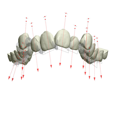 Goede Biocompatibility bevestigde Orthodontische Toestellen Rubberpal