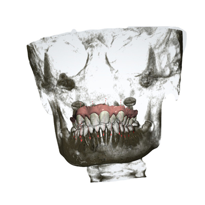 Nauwkeurige Verwijderbare Orthodontische Toestellenoem Snelle Palatale Expander