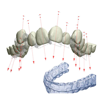 De palsteunen FDA bevestigden Orthodontisch Toestel met 3D