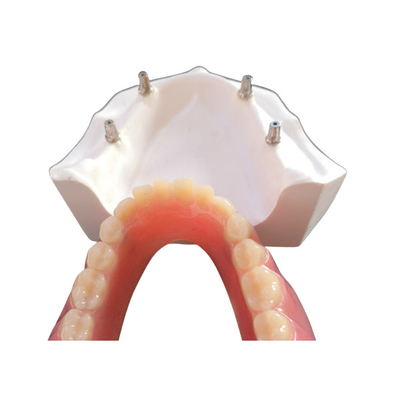 Comfortabele CAD CAM Tandimplant Gemakkelijke Overdenture handhaaft