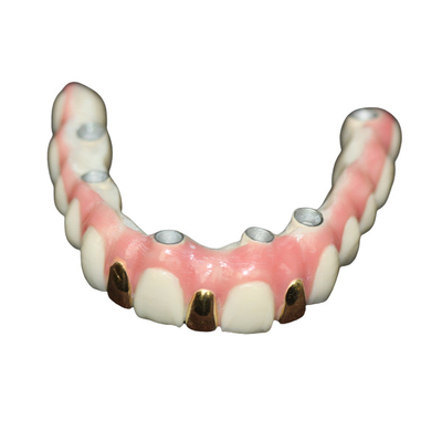 Implant van de precisie Digitaal 3D Druk Tand Gebaseerd Barmetaal