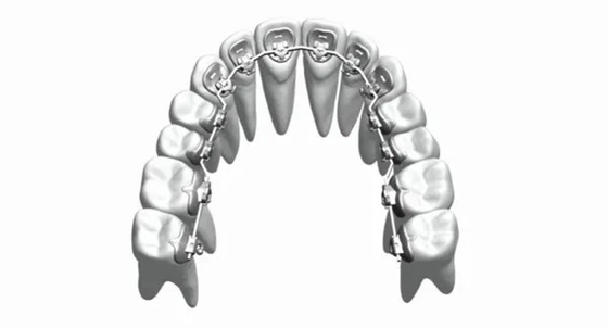 De douane bevestigde Orthodontische Toestellensteunen rechtmaakt Tandenroestvrij staal Bioceramic