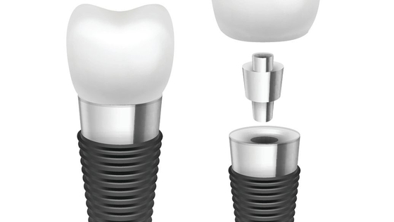 Titanium/van het Kobaltchromium Tandimplant Rod Comfortable Highly Biocompatible Implant