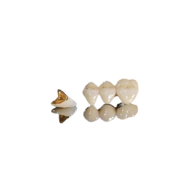Semi Kostbare Implant PFM Kroon Met hoge weerstand voor Tandrestauraties