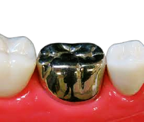 De hoge Hardheids Gouden Implant Weerstand van de de Krooncorrosie van het Kroonedele metaal