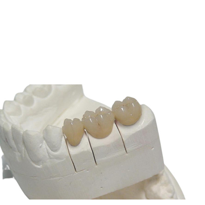 De tijdelijke CAD/CAM PFM Tandaanpassing van het het Ontwerpgebit van de Kroon 3D Druk