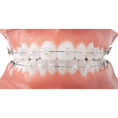 Gemakkelijke Schone Orthodontische Ceramische Steun Mooie Vaste Orthodontische Toestellen