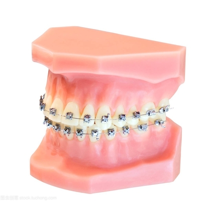 Tandbeugels Vaste orthodontische apparaten Upgrade zachte draadbeugels