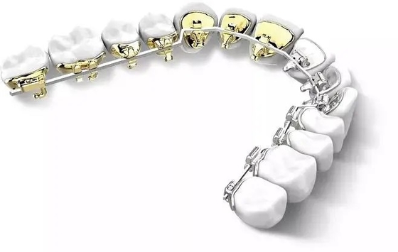 Gebitsbeugels Vaste orthodontische apparaten Zijrug Onzichtbare Linguale beugels Esthetisch natuurlijk