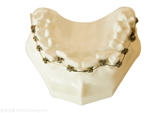 Tandbeugels Orthodontie Vaste tandmodelleringstools Tandbeugels