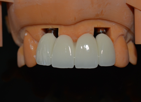 Precieze CAD/CAM-ontwerp Zirconia tandkroon voor montage