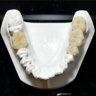 Standvastige Kwaliteit de Mark Of Our Ceramic Dental-Kronen