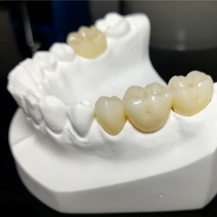 Standvastige Kwaliteit de Mark Of Our Ceramic Dental-Kronen