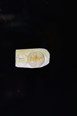 Levensduur en Duurzaamheid een Leveninvestering met Onze Ceramische Tandkronen