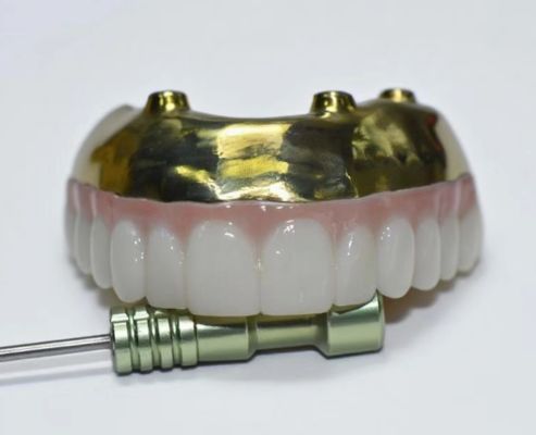 Volledige Zirconia brug met titanium staaf steun