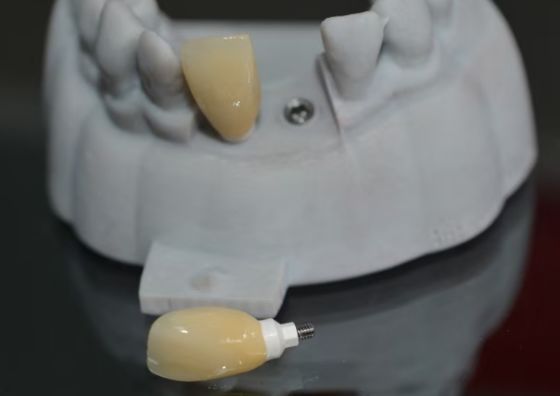 CAD PEEK op maat gemaakte abutment