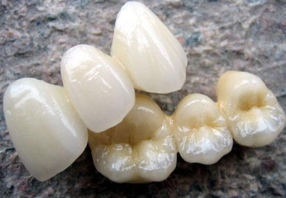 PFM-Cr 3014652903 van Co Ceramische Tand de Kleurenstabiliteit van de Brugdouane