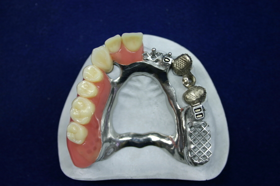 Mooi uiterlijk Precieze bevestiging Prothese Implantaten bevestigingen