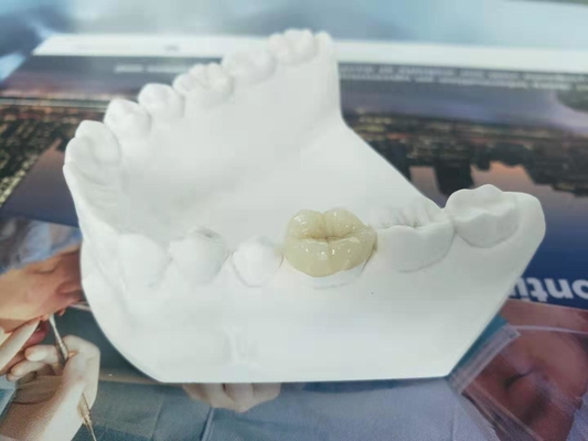 Het duurzame van het de Kroonvernisje van FDA alle-Ceramische Tandinlegsel Gelijkaardige Onlay