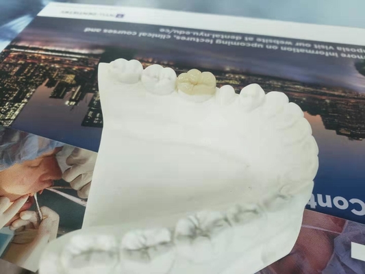 Het duurzame van het de Kroonvernisje van FDA alle-Ceramische Tandinlegsel Gelijkaardige Onlay