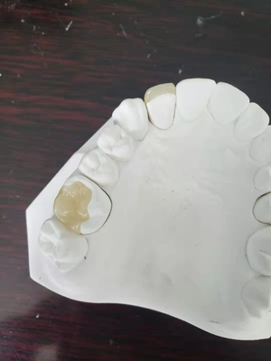 Het duurzame van het de Kroonvernisje van FDA alle-Ceramische Tandinlegsel Gelijkaardige Onlay