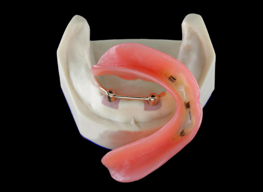 Alle-op-4 titaniumcnc Implant Beveiligde Gebitten voor Tandkliniek