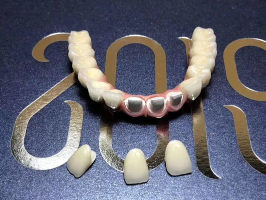 Flexibele Individuele Titanium Verwijderbare Tandkroon voor Tandkliniek