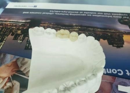 Duurzame Flexibele PFM-Tandips E Max Press Inlay Onlay van de Brugkroon