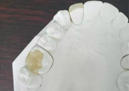 Duurzame Flexibele PFM-Tandips E Max Press Inlay Onlay van de Brugkroon