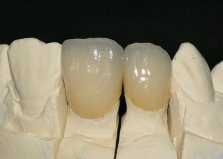 Vlotte Corrosiebestendige Oppervlaktepfm metaal-Ceramische Kroon