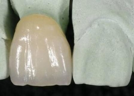 Vlotte Corrosiebestendige Oppervlaktepfm metaal-Ceramische Kroon
