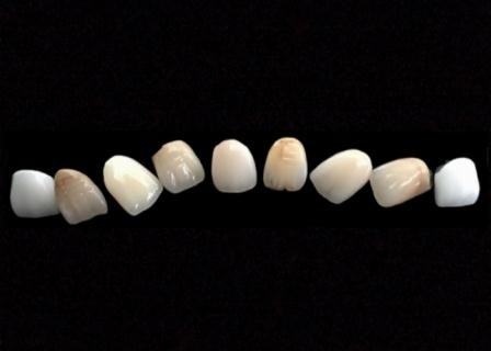 Vlotte Corrosiebestendige Oppervlaktepfm metaal-Ceramische Kroon