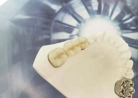 OEM Oppoetsende Porselein Tandkroon Hoge Biologische Intermiscibility