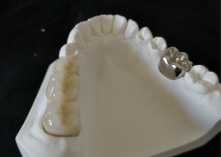 OEM Oppoetsende Porselein Tandkroon Hoge Biologische Intermiscibility