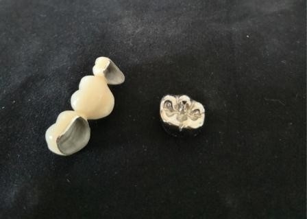 OEM Oppoetsende Porselein Tandkroon Hoge Biologische Intermiscibility