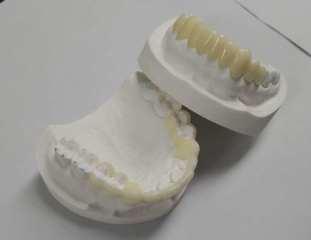 Hoge duurzaamheid CAD CAM 3D-printen Tijdelijke kronen Duurzame hars