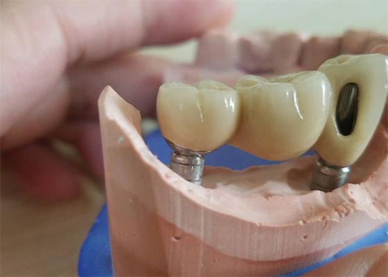 CAD CAM Zirconiumdioxyde Tandkroon met het Zirconiumdioxydesteunpunt van de Titaniumbasis
