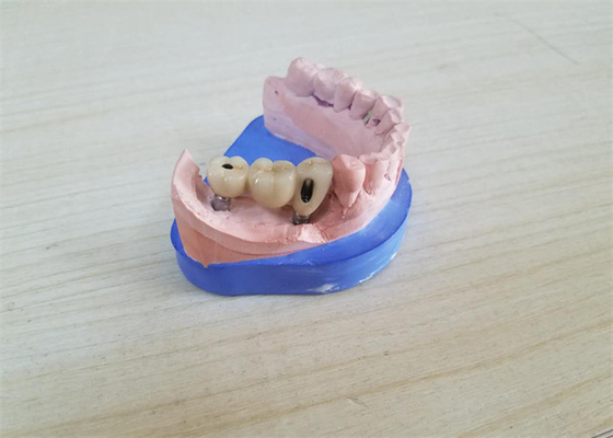 CAD CAM Zirconiumdioxyde Tandkroon met het Zirconiumdioxydesteunpunt van de Titaniumbasis