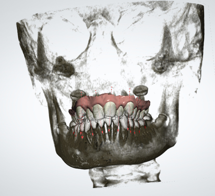 Nauwkeurige Verwijderbare Orthodontische Toestellenoem Snelle Palatale Expander