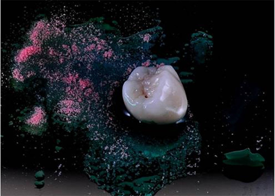 Ultra Harde Oppoetsende Implant van de Vernisje alle-Ceramische Kroon Gebitten Tand