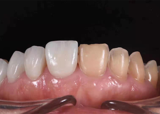 0.3MM Wittende Ceramische Tandkroon om Ongezonde Tanden te vervangen