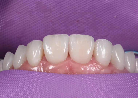 0.3MM Wittende Ceramische Tandkroon om Ongezonde Tanden te vervangen