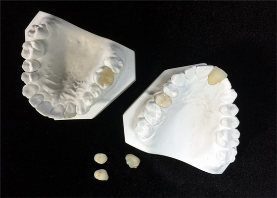 Gemakkelijk handhaaf OEM het Witte Ceramische Tandinlegsel Onlay van het Kroonvernisje